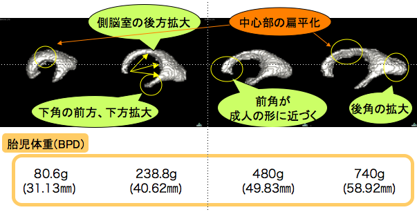胎児側脳室の形態と長さ計測の有用性（竹谷卒論） Congenit Anomに掲載