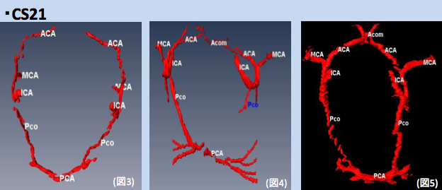 Willis輪の形成についての論文Congenit Anomに掲載