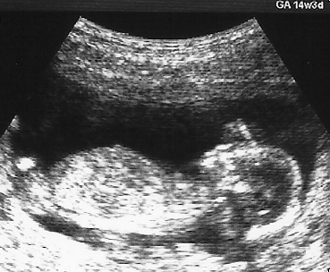 胎児超音波検査 (産婦人科領域のエコー) について