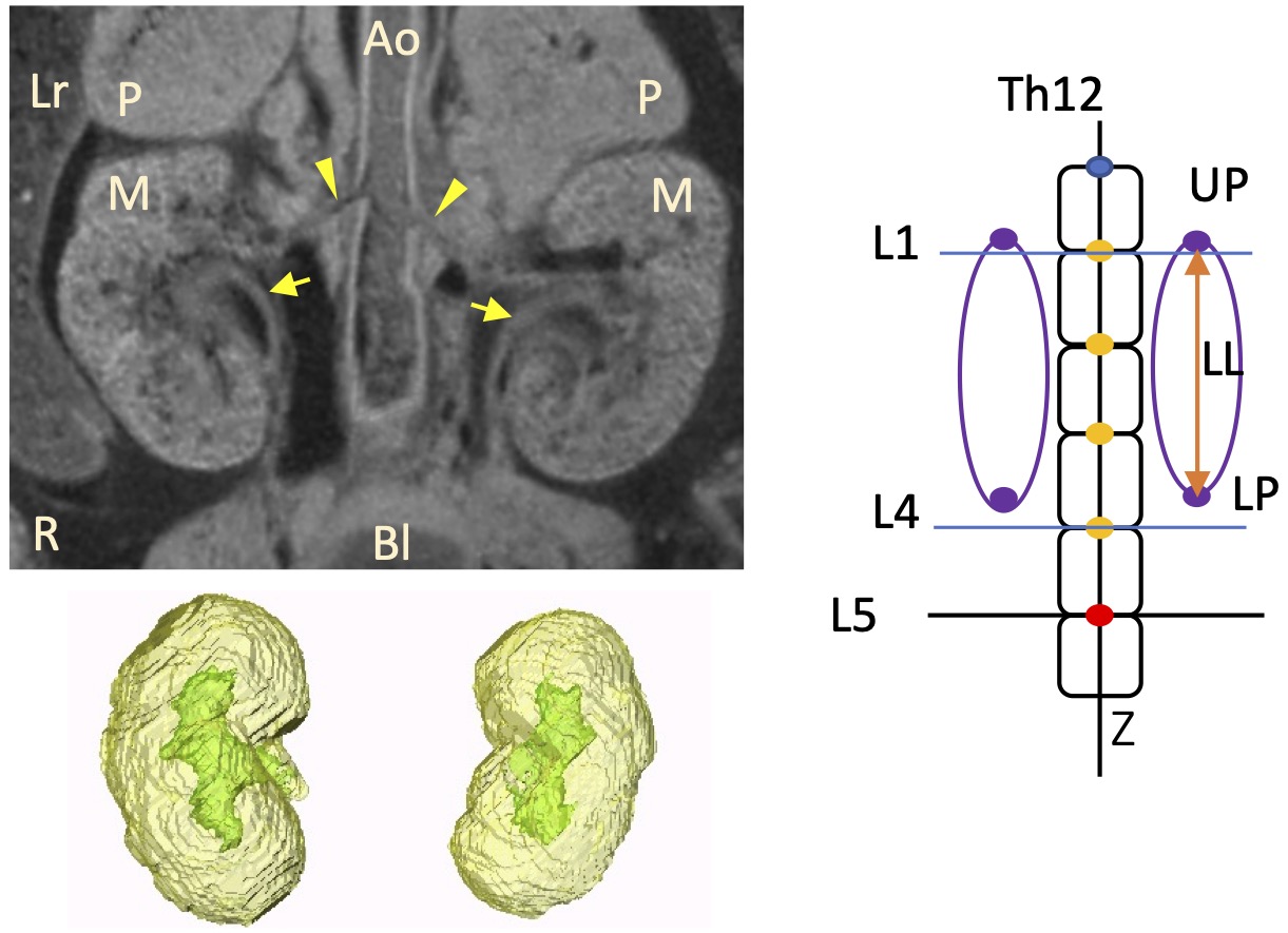 腎臓の高さの左右差についてがCongenital Anomaliesに掲載